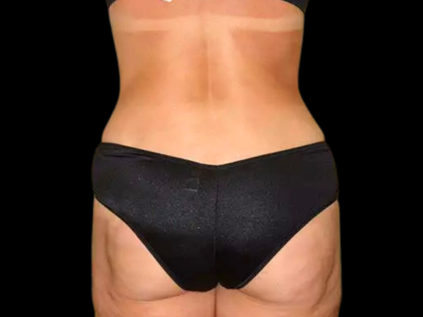 Liposuction Patient 05 After 2