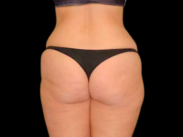 Liposuction Patient 05 Before 2