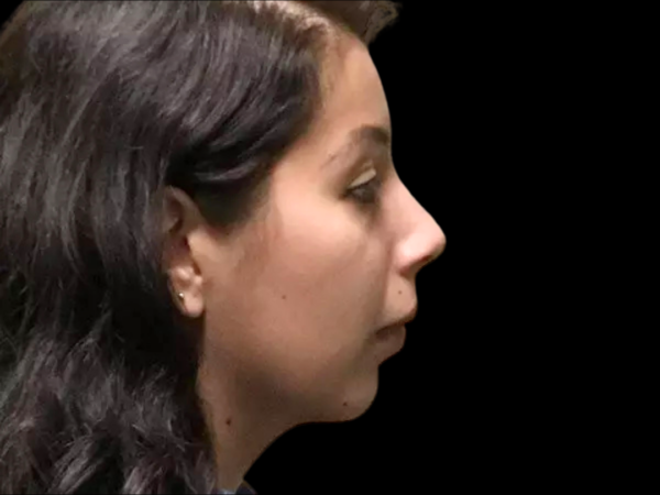 Chin Augmentation Patient 02 Before 1