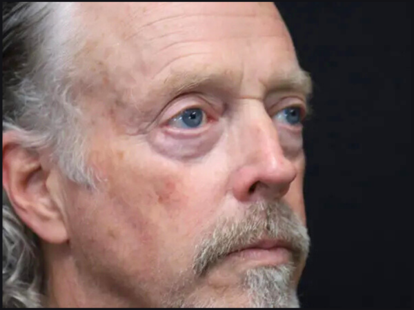 Eyelid Surgery Patient 25 Before 1