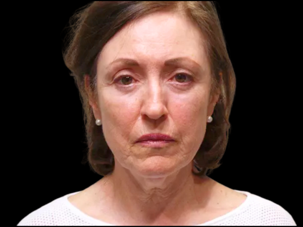 Facelift Patient 03 Before 1