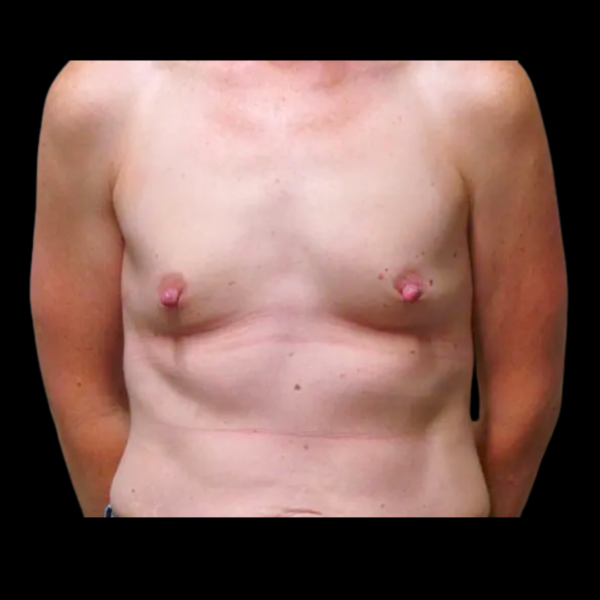 Breast Augmentation Patient 61 Before 1