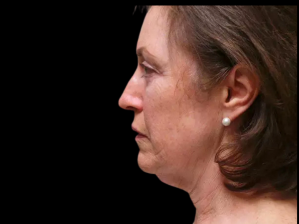 Facelift Patient 03 Before 2