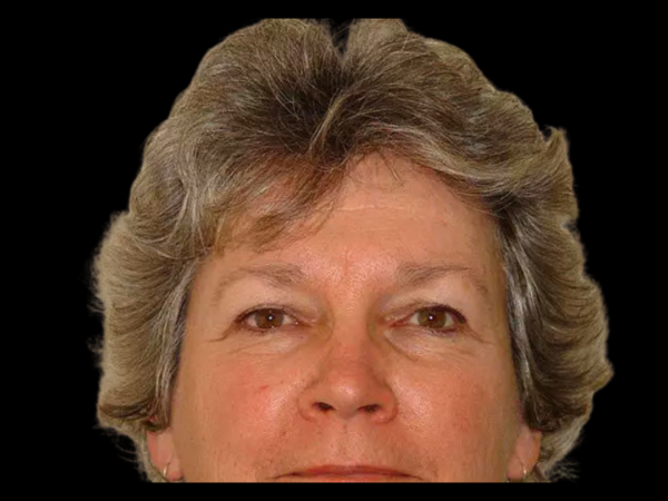 Brow Lift Patient 04 Before 1