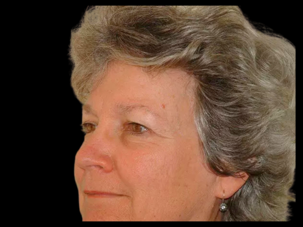 Brow Lift Patient 04 Before 2