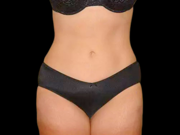 Liposuction Patient 05 After 1
