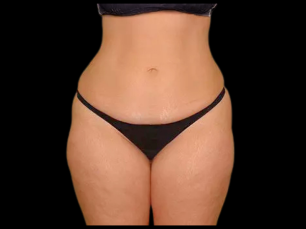 Liposuction Patient 05 Before 1