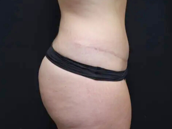 Abdominoplasty Case 26 After 1