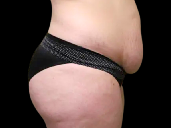 Abdominoplasty Case 26 Before 1