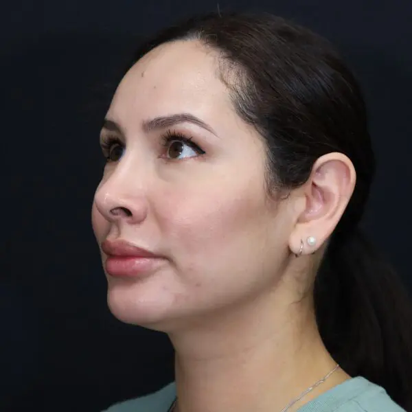 Rhinoplasty #2080 After 1