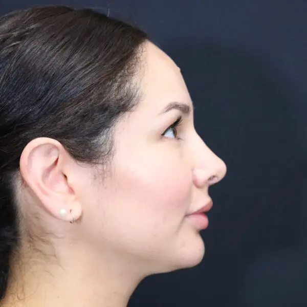 Rhinoplasty #2080 After 2