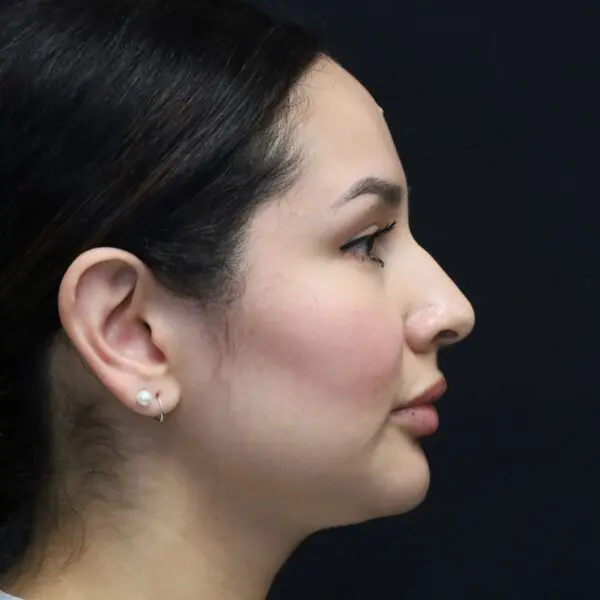 Rhinoplasty #2080 Before 2