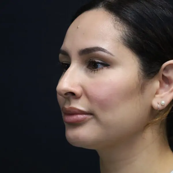 Rhinoplasty #2080 Before 1