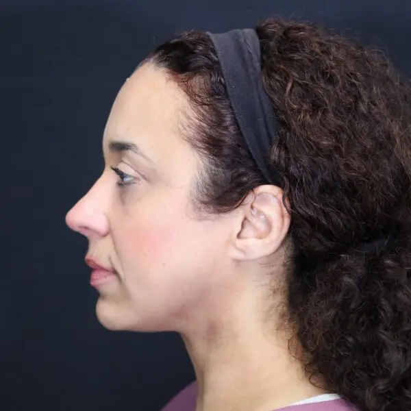 Rhinoplasty #7243 After 2