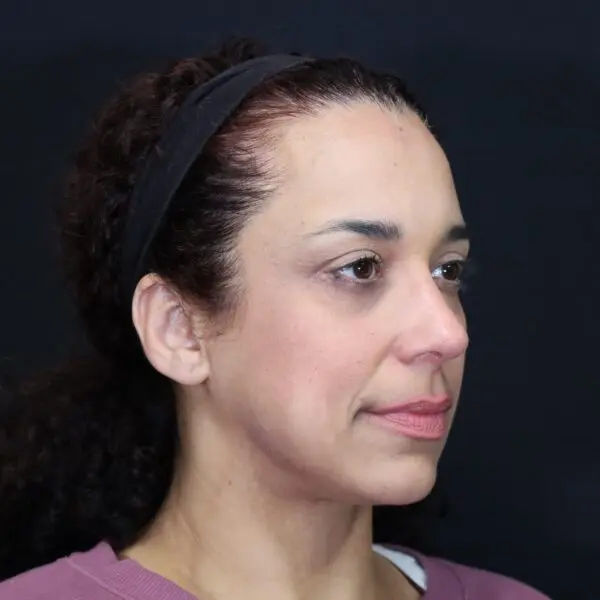 Rhinoplasty #7243 After 1