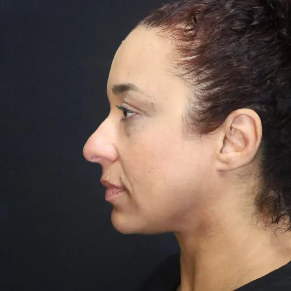 Rhinoplasty #7243 Before 2