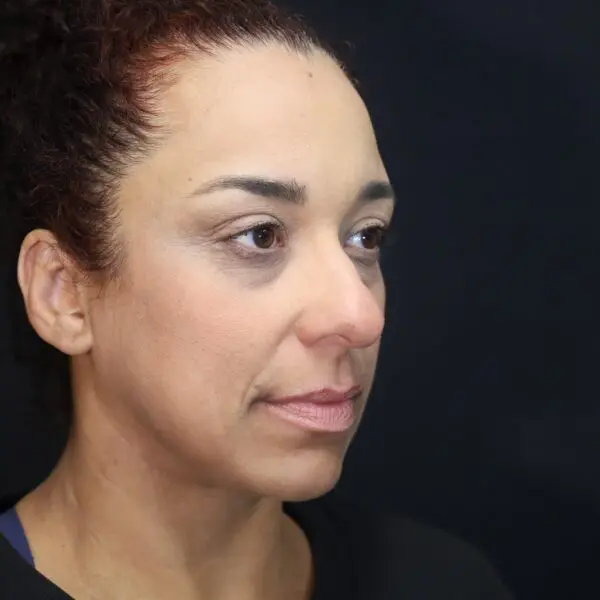 Rhinoplasty #7243 Before 1