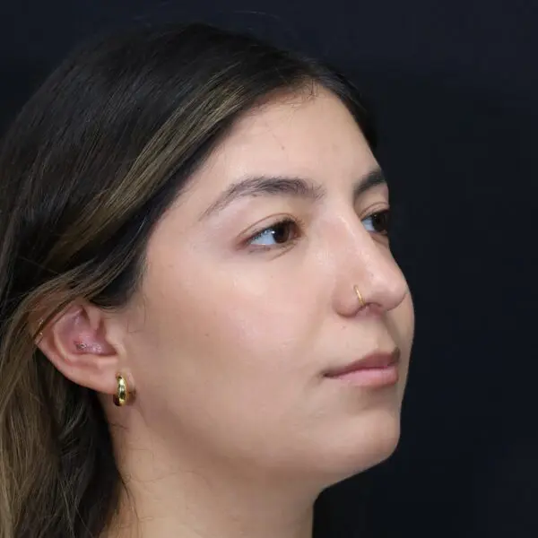 Rhinoplasty #6317 After 1