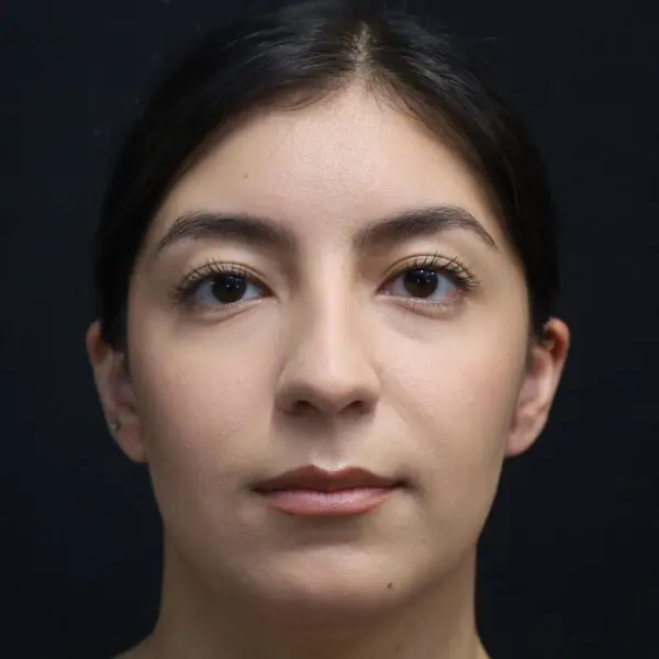 Rhinoplasty #6317 Before 2