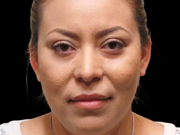 Eyelid Surgery Patient 06 After 2