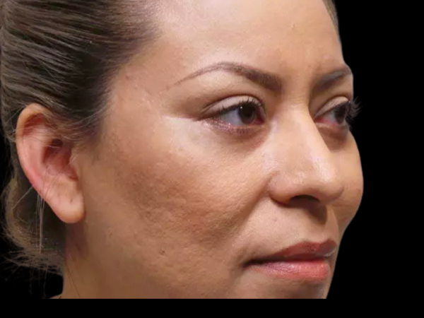 Eyelid Surgery Patient 06 After 1