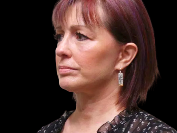 FaceLift Patient 02 After 1