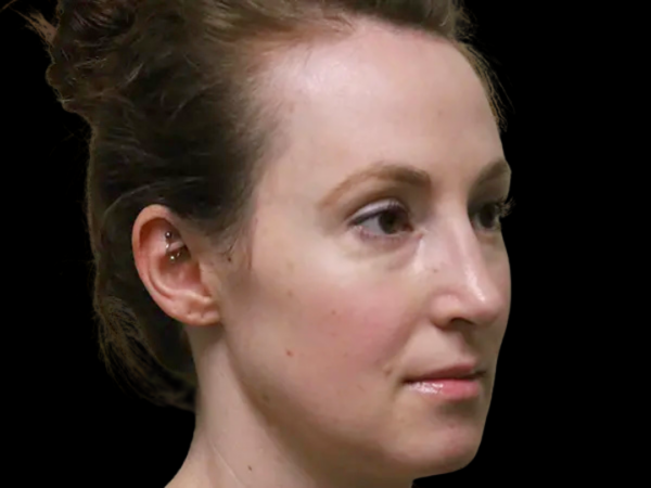 Rhinoplasty Patient 50 After 1