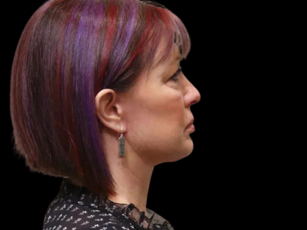 FaceLift Patient 02 After 2