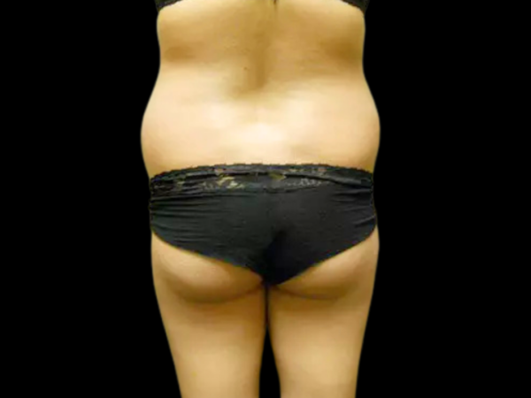 Liposuction Patient 06 Before 2