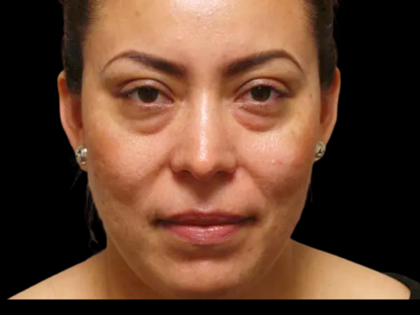 Eyelid Surgery Patient 06 Before 2