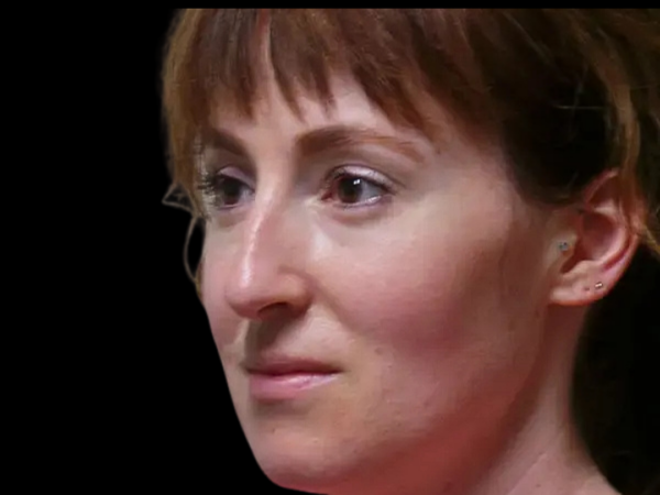 Rhinoplasty Patient 50 Before 2