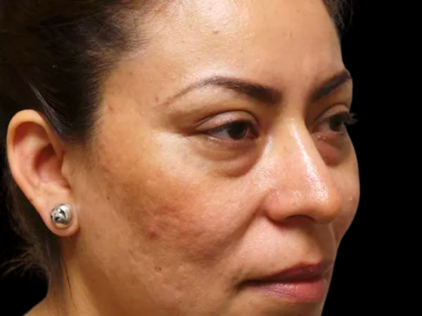 Eyelid Surgery Patient 06 Before 1