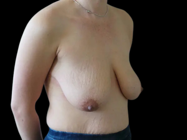 Breast Augmentation with Lift Patient 36 Before 1