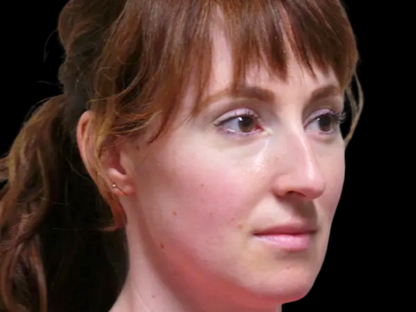 Rhinoplasty Patient 50 Before 1