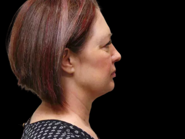 FaceLift Patient 02 Before 2