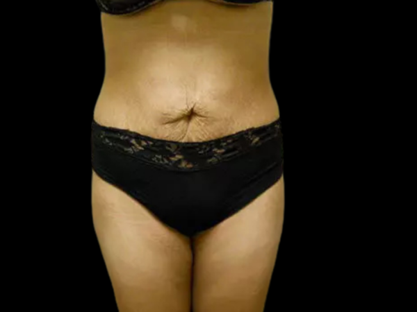 Liposuction Patient 06 After 1