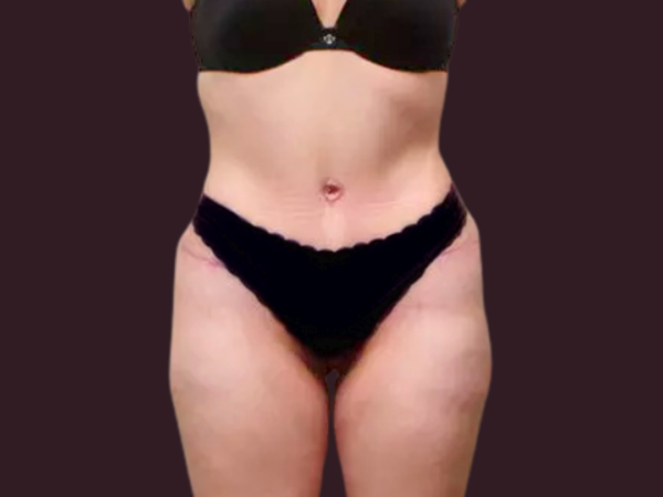 Tummy Tuck Patient 02 After 1