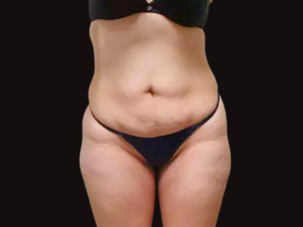 Tummy Tuck Patient 02 Before 1