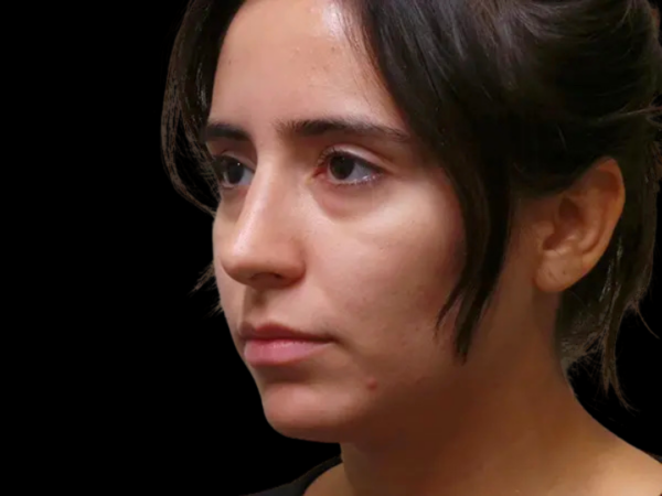 Rhinoplasty Patient 34 After 1