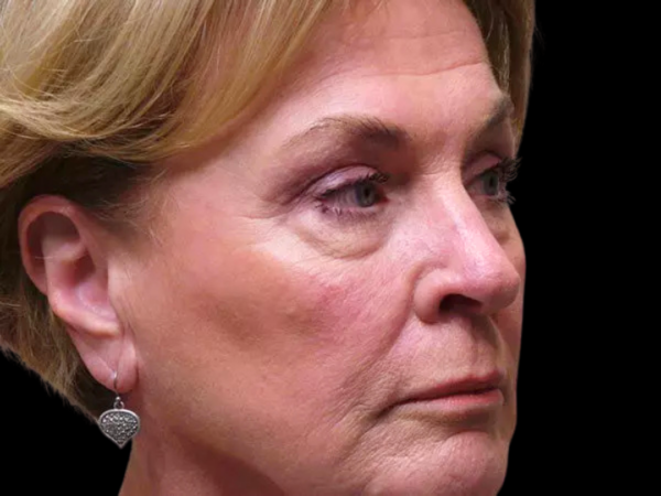 Eyelid Surgery Patient 05 After 2