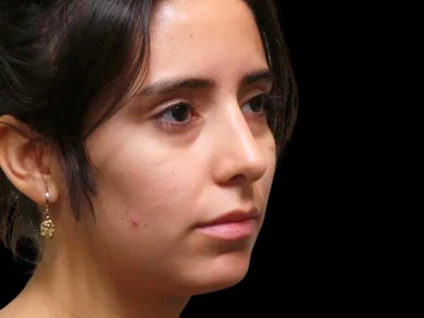 Rhinoplasty Patient 34 After 2