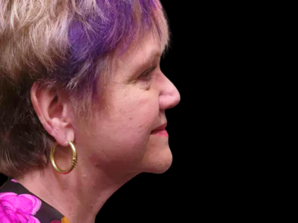 FaceLift Patient 06 After 1