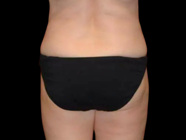 Liposuction Patient 07 After 1