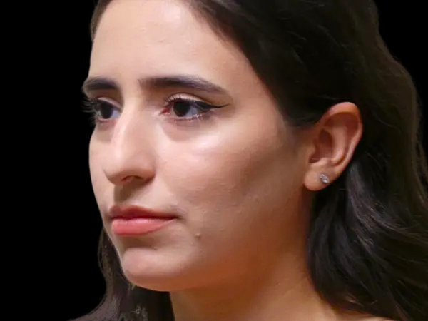 Rhinoplasty Patient 34 Before 1