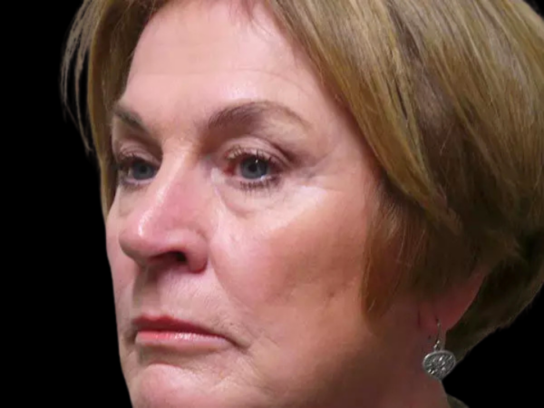 Eyelid Surgery Patient 05 Before 1