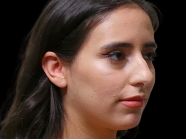 Rhinoplasty Patient 34 Before 2