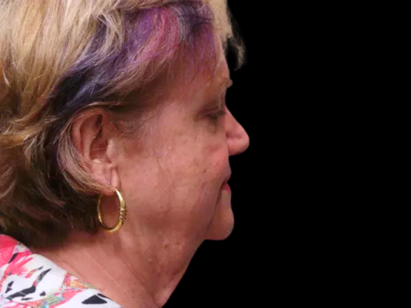 FaceLift Patient 06 Before 1