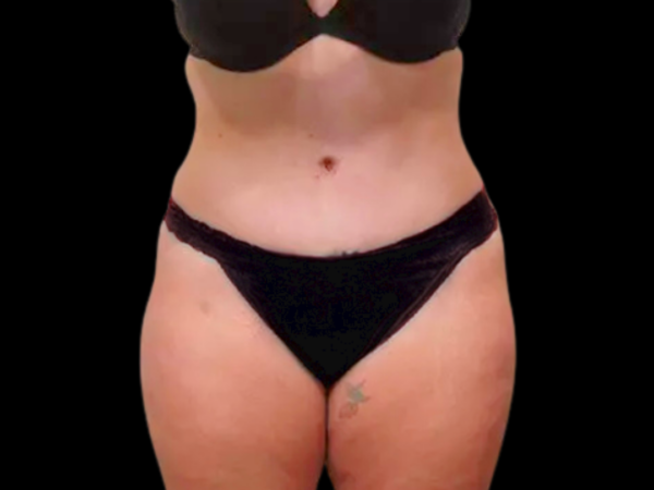 Tummy Tuck Patient 03 After 1