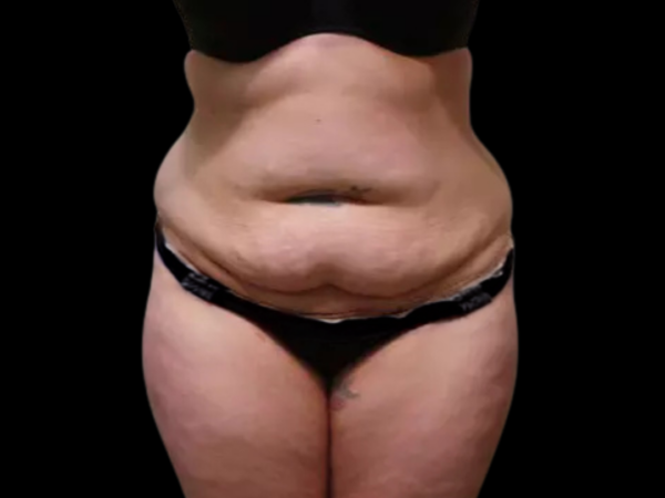 Tummy Tuck Patient 03 Before 1