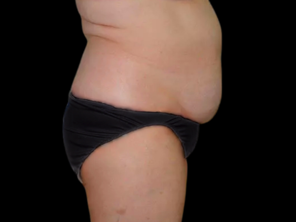 Liposuction Patient 07 Before 2